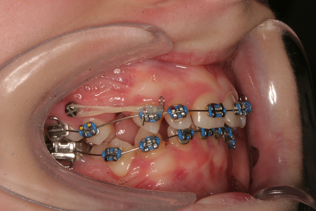 Loss of anchorage of miniscrews: A 3-dimensional assessment